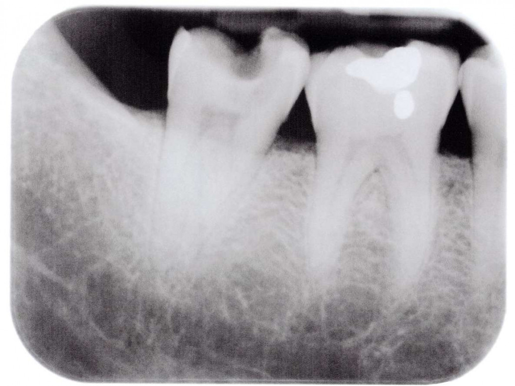 Dental Fillings | Broken Arrow, OK | Shoop Family Dentistry